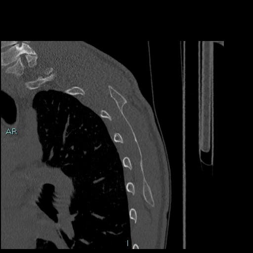 Avascular necrosis after fracture dislocations of the proximal humerus (Radiopaedia 88078-104655 Sagittal bone window 79).jpg
