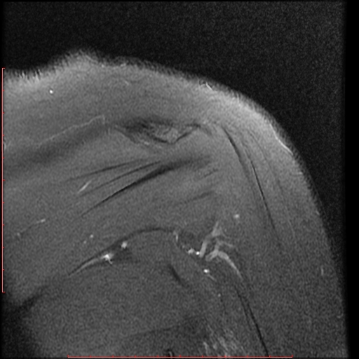 File:Avulsion fracture - greater tuberosity of humerus (Radiopaedia 25457-25703 Coronal PD 12).jpg