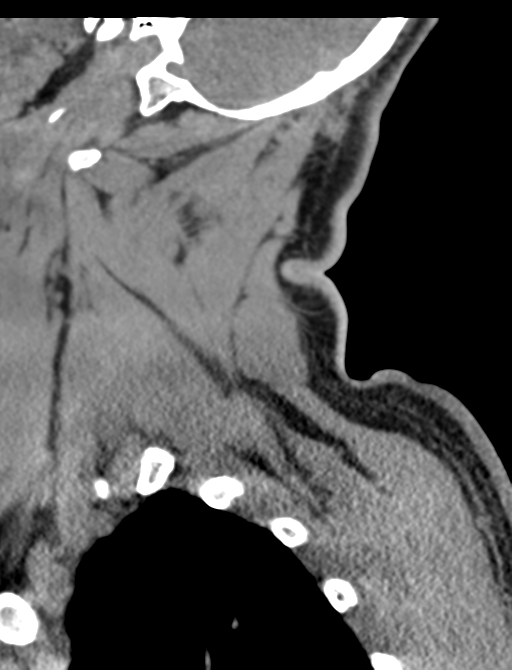 Axis peg fracture (type 3) and atlas lateral mass (type 4) fracture (Radiopaedia 37474-39324 D 11).png