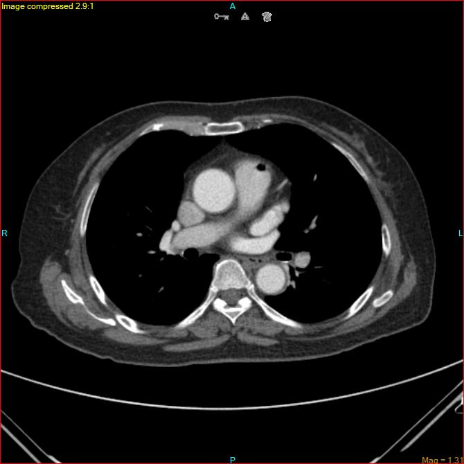Azygos vein aneurysm (Radiopaedia 77824-90130 B 30).jpg