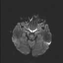 Balo concentric sclerosis (Radiopaedia 50458-55940 Axial DWI 60).jpg