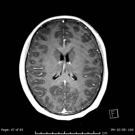 Balo concentric sclerosis (Radiopaedia 61637-69636 Axial T1 C+ 47).jpg