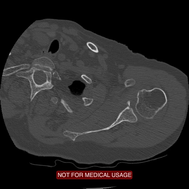 Bankart lesion (Radiopaedia 41497-44401 Axial bone window 56).jpg