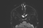 File:Basal cell carcinoma - nasal region (Radiopaedia 70292-80365 Axial DWI 29).jpg