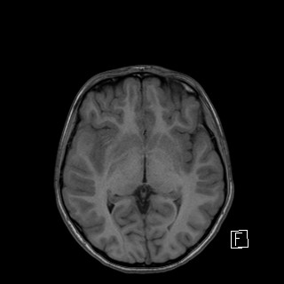 Base of skull rhabdomyosarcoma (Radiopaedia 32196-33142 Axial T1 25).jpg