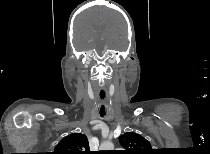 Basilar artery aneurysm (Radiopaedia 56261-62932 B 21).jpg