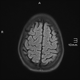File:Basilar artery perforator aneurysm (Radiopaedia 82455-99523 Axial FLAIR 19).jpg