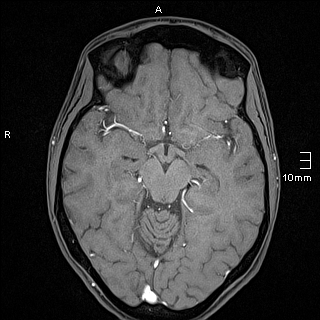 Basilar artery perforator aneurysm (Radiopaedia 82455-99523 F 61).jpg
