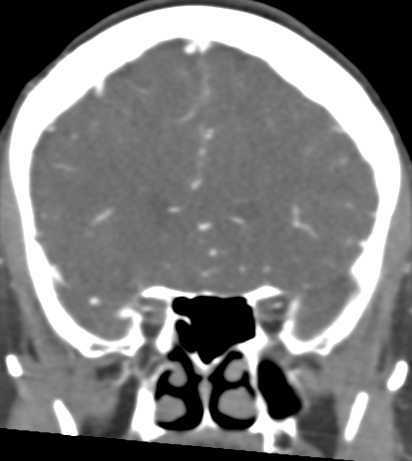 File:Basilar tip aneurysm with coiling (Radiopaedia 53912-60086 B 45).jpg