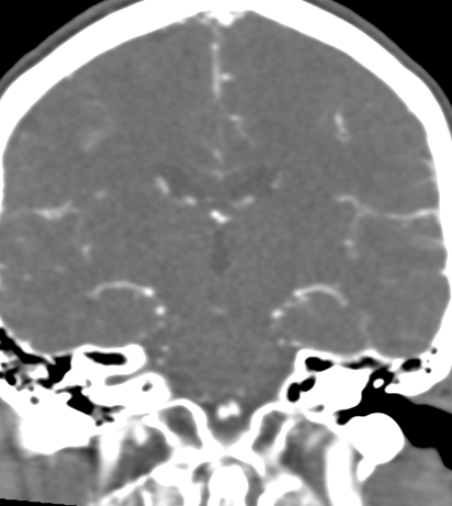 File:Basilar tip aneurysm with coiling (Radiopaedia 53912-60086 B 86).jpg
