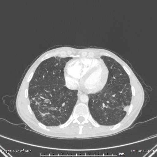File:Behçet disease (Radiopaedia 44247-47889 Axial lung window 64).jpg