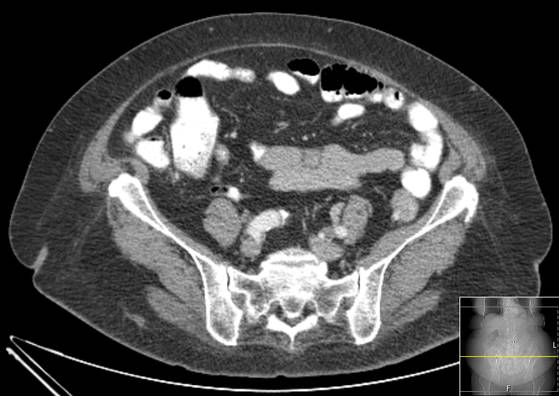 Bicameral celiacomesenteric aneurysm (Radiopaedia 55766-62327 A 48).jpg