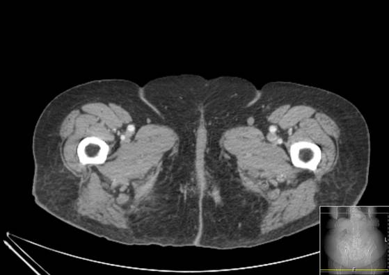 Bicameral celiacomesenteric aneurysm (Radiopaedia 55766-62327 A 84).jpg