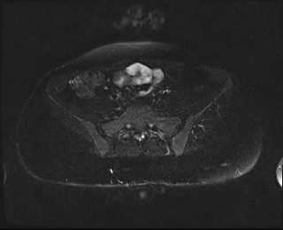 File:Bicornuate bicollis uterus (Radiopaedia 61626-69616 Axial PD fat sat 5).jpg