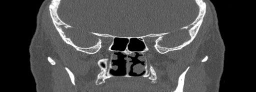 Bilateral Ectopic Infraorbital Nerves (Radiopaedia 49006-54084 Coronal bone window 62).jpg