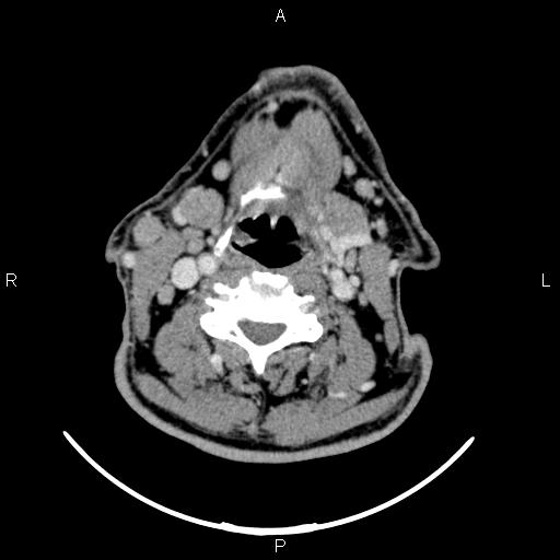 Bilateral Warthin tumors (Radiopaedia 84034-99263 Axial With contrast 37).jpg