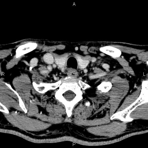 File:Bilateral Warthin tumors (Radiopaedia 84034-99263 Axial With contrast 59).jpg