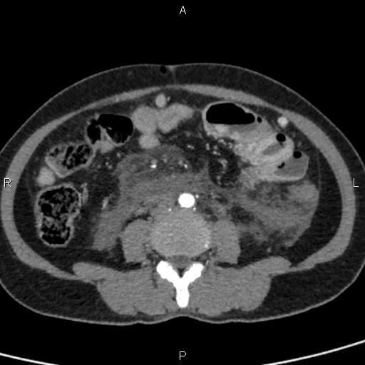 Bilateral adrenal gland hyperenhancement in pancreatitis (Radiopaedia 86642-102753 B 81).jpg