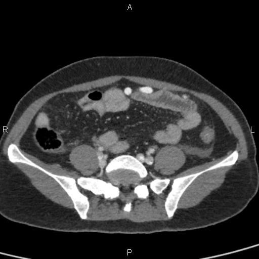Bilateral adrenal gland hyperenhancement in pancreatitis (Radiopaedia 86642-102753 E 81).jpg