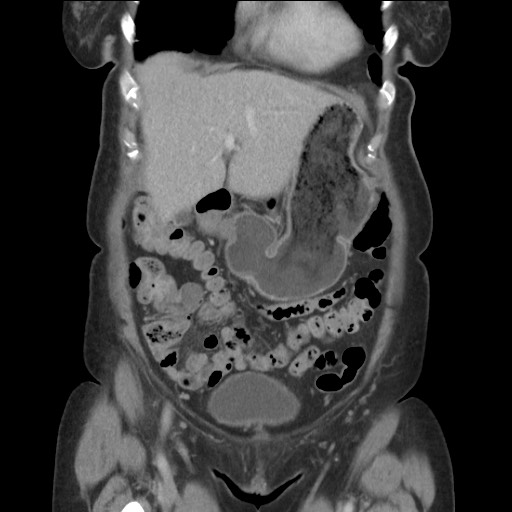 Bilateral adrenal granulocytic sarcomas (chloromas) (Radiopaedia 78375-91007 B 28).jpg