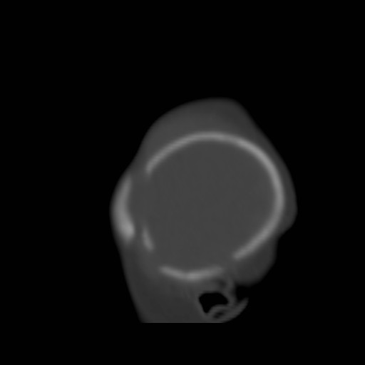 File:Bilateral cephalohematomas and subdural hematomas (Radiopaedia 26778-26929 Sagittal bone window 38).jpg