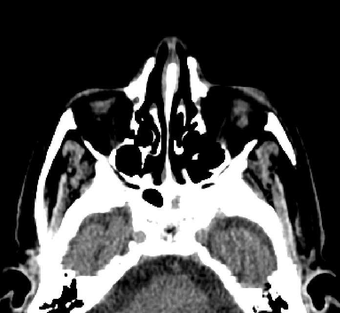 Bilateral ectopia lentis (Radiopaedia 89889-107013 Axial non-contrast 68).jpg
