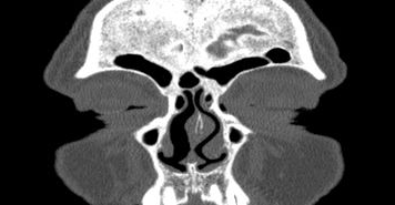 File:Bilateral ectopic infraorbital nerves (Radiopaedia 49006-54084 Coronal 66).png