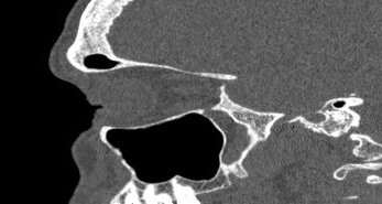 File:Bilateral ectopic infraorbital nerves (Radiopaedia 49006-54084 Sagittal 26).png