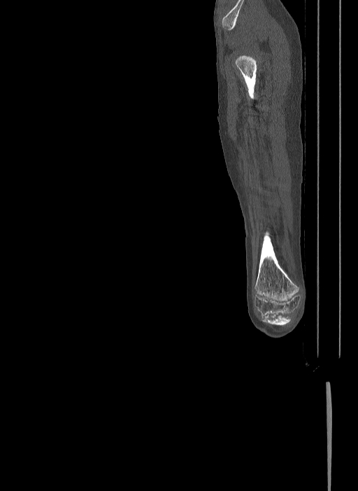 Bilateral fibular hemimelia type II (Radiopaedia 69581-79491 Sagittal bone window 68).jpg