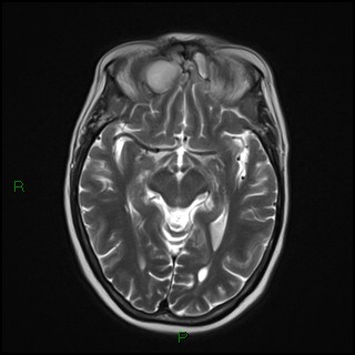 File:Bilateral frontal mucoceles (Radiopaedia 82352-96455 Axial T2 9).jpg