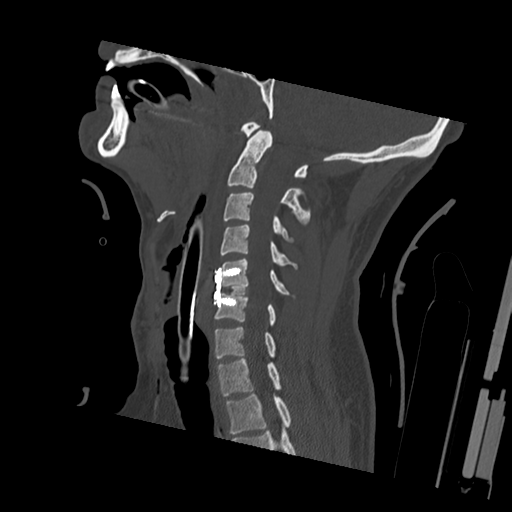 Bilateral locked facets (Radiopaedia 33850-35023 Sagittal bone window 32).png