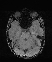 Bilateral mesial temporal polymicrogyria (Radiopaedia 76456-88181 Axial SWI 19).jpg