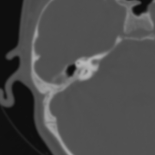 Bilateral otosclerosis (Radiopaedia 57237-64157 B 75).jpg
