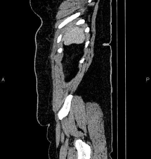 Bilateral ovarian dermoid cysts (Radiopaedia 85785-101603 D 90).jpg