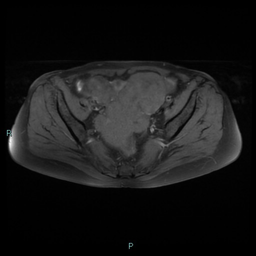 File:Bilateral ovarian fibroma (Radiopaedia 44568-48293 Axial T1 fat sat 12).jpg
