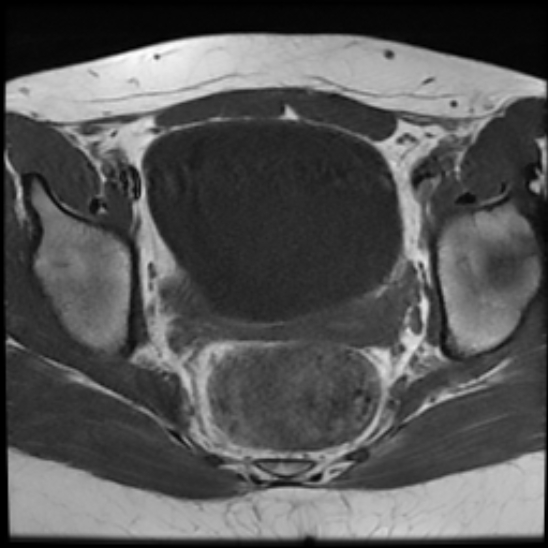 File:Bilateral ovarian fibrothecomas - adolescent (Radiopaedia 86604-102707 Axial T1 19).jpg