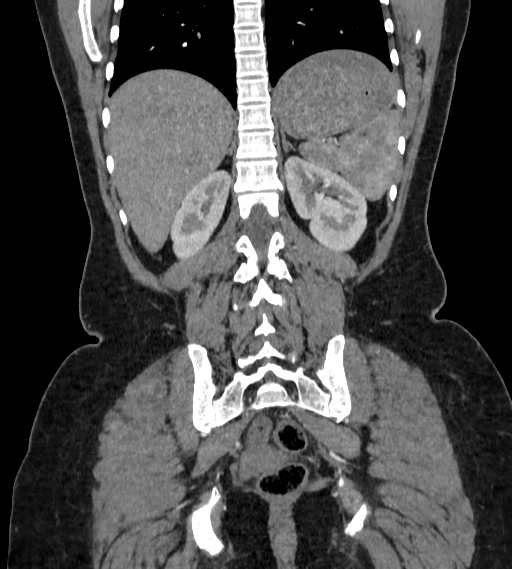 File:Bilateral ovarian mature cystic teratomas (Radiopaedia 79373-92457 B 73).jpg