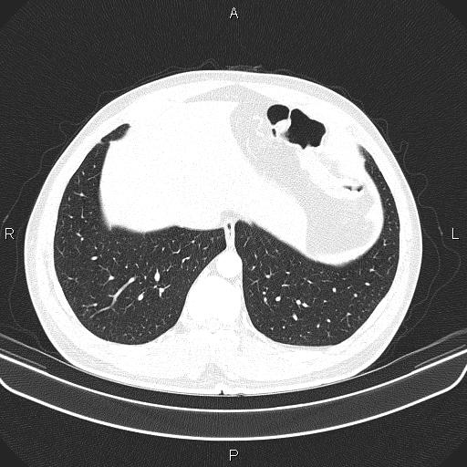 File:Bilateral pulmonary AVM (Radiopaedia 83134-97505 Axial lung window 60).jpg