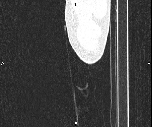 Bilateral pulmonary AVM (Radiopaedia 83134-97505 Sagittal lung window 119).jpg