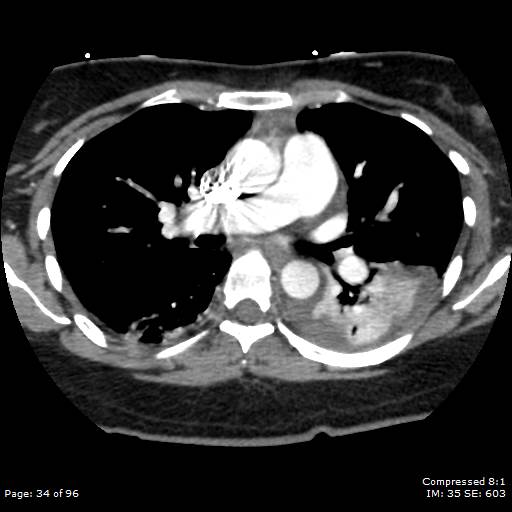 Bilateral pulmonary emboli with Hampton hump sign (Radiopaedia 54070-60246 Axial C+ CTPA 31).jpg