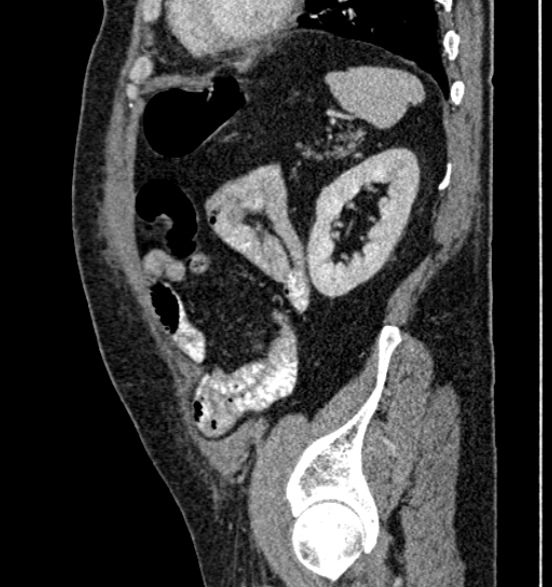 Bilateral rectus sheath hematomas (Radiopaedia 50778-56252 B 61).jpg