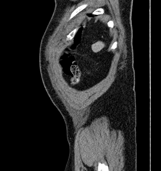 Bilateral rectus sheath hematomas (Radiopaedia 50778-56252 B 73).jpg
