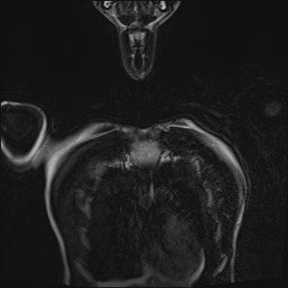 Bilateral spinoglenoid notch ganglion cysts (Radiopaedia 29577-30082 Coronal T2 12).jpg