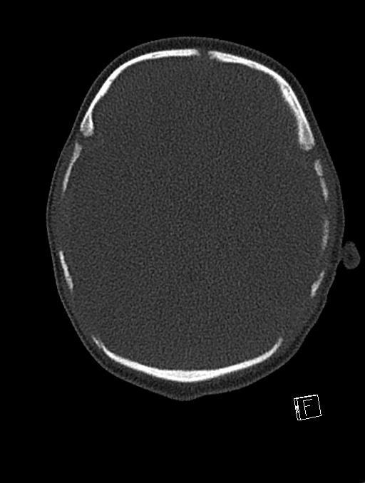 Bilateral subdural hemorrhage and parietal skull fracture (Radiopaedia 26058-26192 Axial bone window 86).png