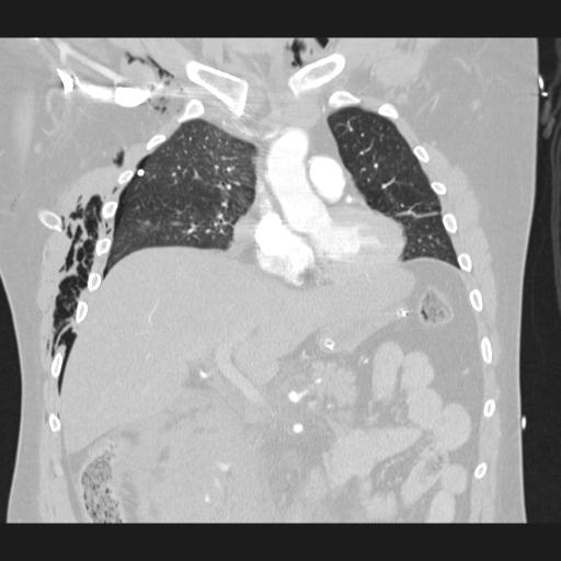 Bilateral traumatic renovascular injury (Radiopaedia 32051-32995 Coronal lung window 34).jpg