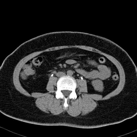 Bilateral ureteric stents (Radiopaedia 48795-53825 Axial non-contrast 32).jpg