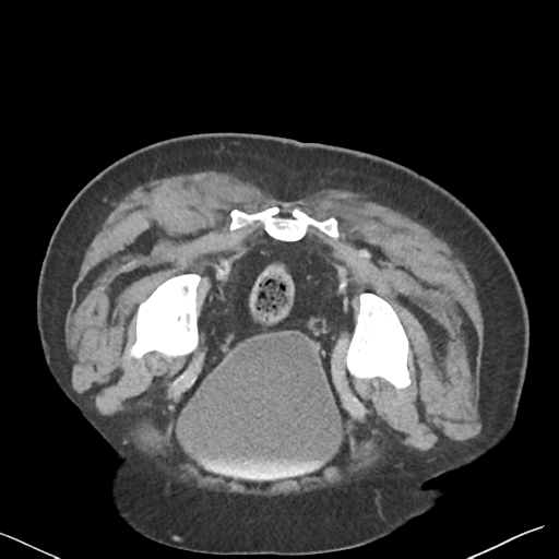 File:Bladder papillary urothelial carcinoma (Radiopaedia 48119-52951 Axial C+ delayed 52).png
