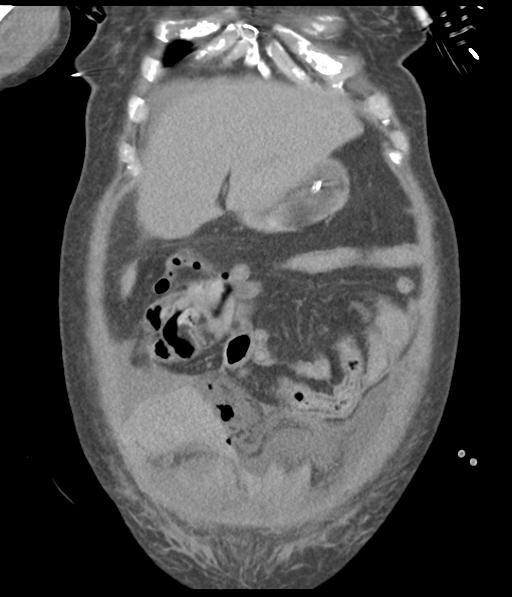 Bladder rupture post renal biopsy (Radiopaedia 30863-31572 Coronal non-contrast 16).jpg