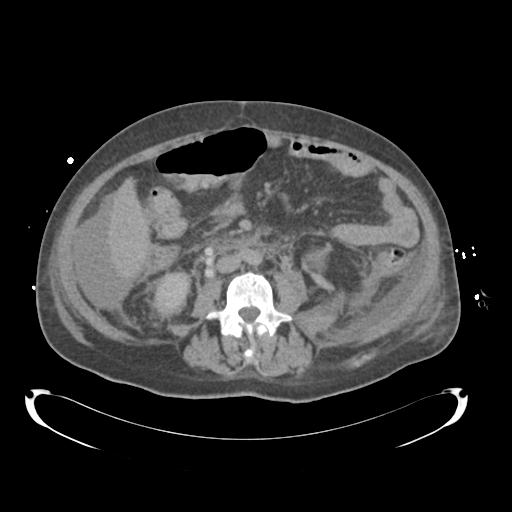 Bladder rupture post renal biopsy (Radiopaedia 30863-31572 Coronal non-contrast 58).jpg