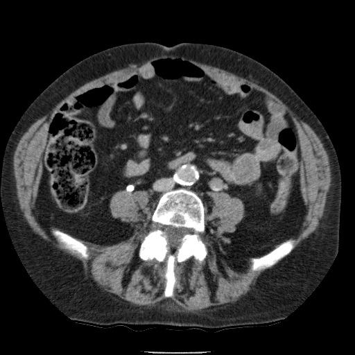Bladder tumor detected on trauma CT (Radiopaedia 51809-57609 C 82).jpg